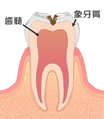 虫歯画像