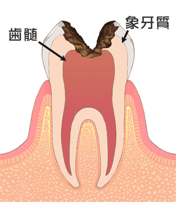 虫歯画像