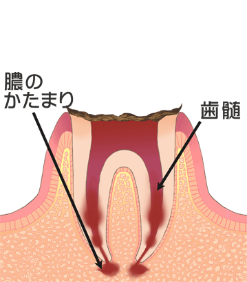 虫歯画像