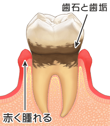 歯周炎画像