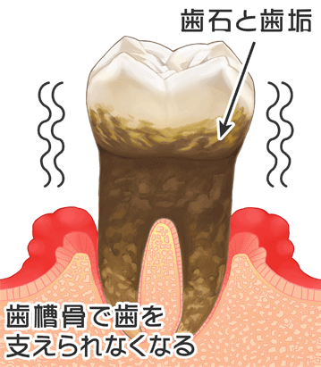 歯周病画像